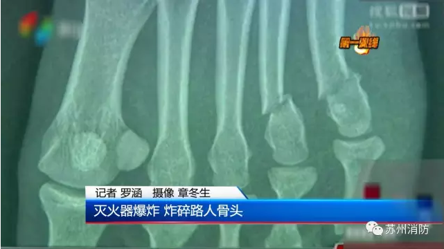 滅火器爆炸 炸碎路人骨頭